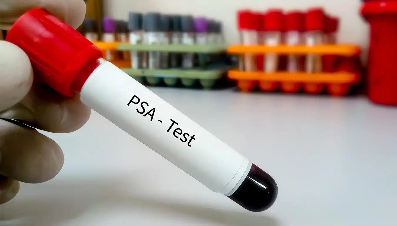 What is PSA Test?