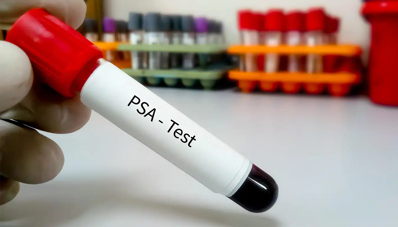 what-is-psa-test-28.webp