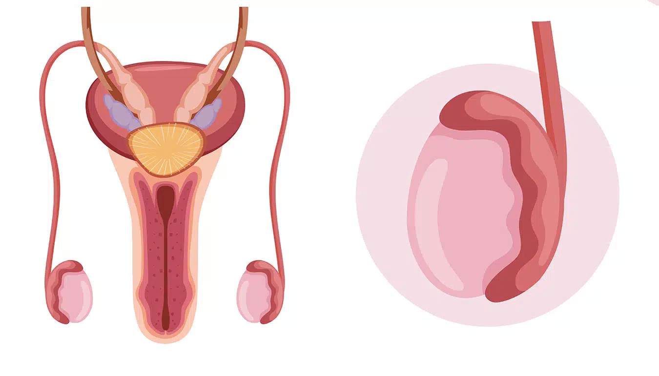 What Is Testicular Cancer?