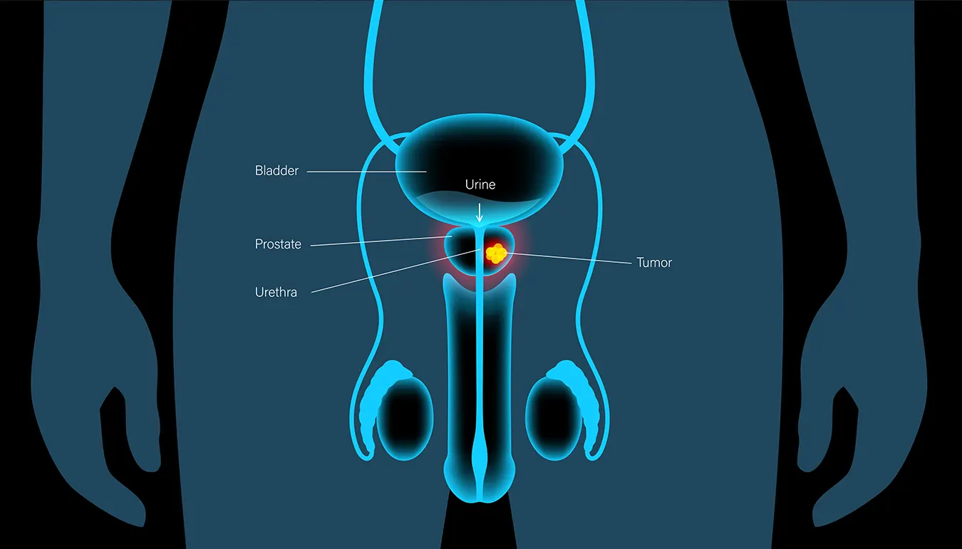 what-is-thulium-laser-28.webp